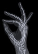 X ray radiograph of hand seen sideways spreading fingers
