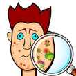 Teenager boy with acne