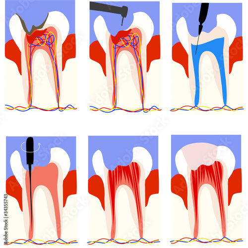 Illustration: wurzelbehandlung wurzelbehandlung