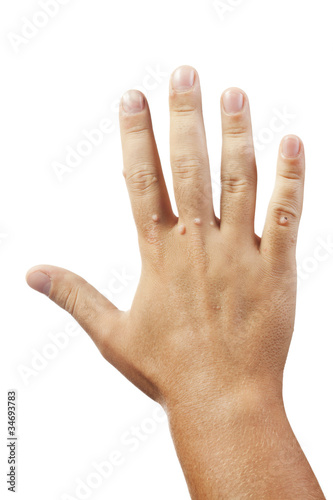 Foto: hand with warts isolated on white background hand with warts isolated on white background