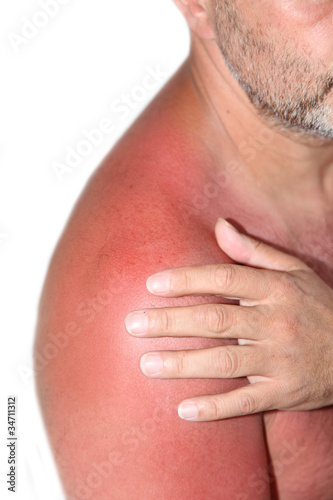 Foto: Sonnenbrand Sonnenbrand