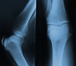 X-ray of the knee.