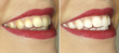Zähne vor und nach dem Bleaching