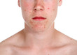 Pimple
