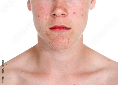 Photo: Pimple Pimple