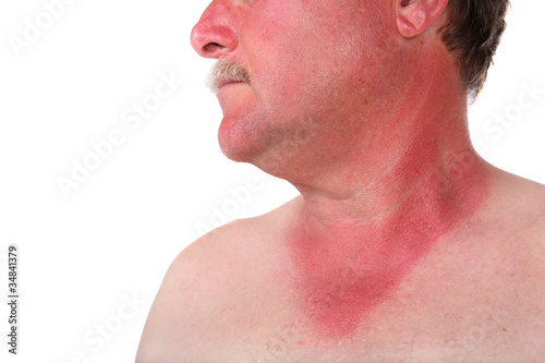 Photo: Man with a sunburn Man with a sunburn