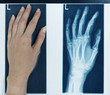 röntgenbild linke hand
