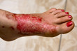 Photo: Severe burns in the women Severe burns in the women