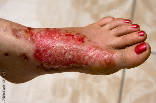 Photo: Severe burns in the women Severe burns in the women