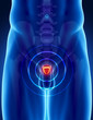 Prostate cancer concept