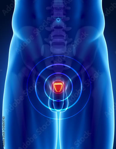 Illustration: Prostate cancer concept Prostate cancer concept