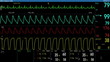 EKG Screen Loopable EKG Screen Loopable