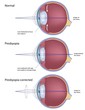Eye condition :presbyopia, eps8