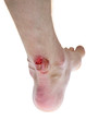 wound on the leg with blood wound on the leg with blood