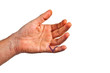 hand with an operation wound at the small finger hand with an operation wound at the small finger