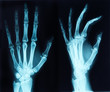 x-ray of a hand