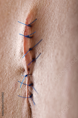 Photo: Dramatically lightened back surgery close-up. Dramatically lightened back surgery close-up.