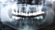 implant