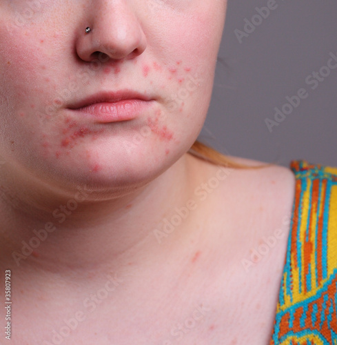 Foto: Image of acne on face Image of acne on face