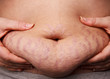 Woman pinching post-pregnancy tummy with stretch marks