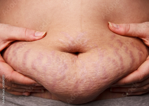 Photo: Woman pinching post-pregnancy tummy with stretch marks Woman pinching post-pregnancy tummy with stretch marks