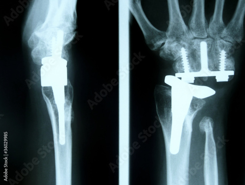Foto: Rheumahand mit Prothese Rheumahand mit Prothese