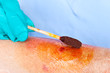 Doctor cleaning wound