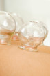 Fire Cupping Detail