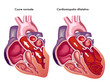Cardiomiopatia dilatativa