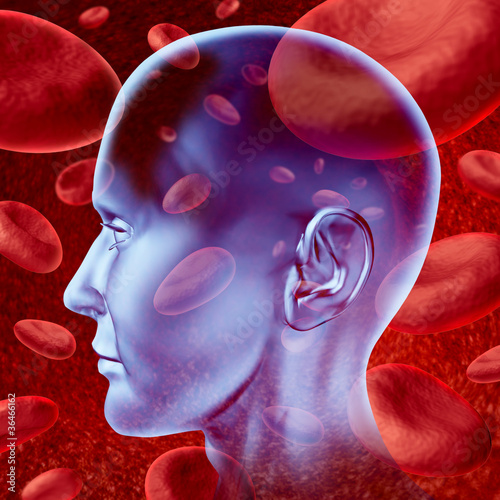 Illustration: Brain stroke Brain stroke