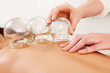 Photo: Fire Cupping Removal of Glass Globe Fire Cupping Removal of Glass Globe
