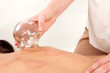 Acupuncturist Removing Fire Cupping Bulb