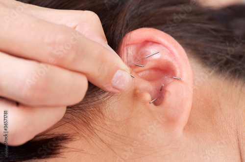 Photo: Ear Acupuncture Detail Ear Acupuncture Detail