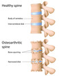 Osteoarthritis of the spine, eps8