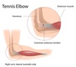 Tennis elbow, eps8