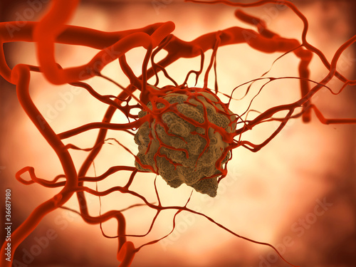 Illustration: Tumor Tumor