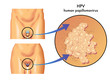 HPV (papilloma virus umano)