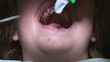 Vídeo : Fixing the wire with elastormerics Fixing the wire with elastormerics