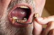 Hand legt Zahnprothese in den Mund
