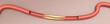 Arteriosklerose