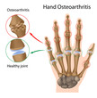 Osteoarthritis of the hand, eps8