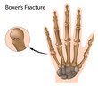 Boxer's fracture, eps8