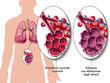 Enfisema polmonare