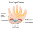 Carpal tunnel syndrome, eps8