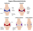 Stages of rheumatoid arthritis, eps8