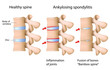 Ankylosing  spondylitis of the spine, eps8