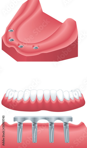 Vector: dental implants dental implants
