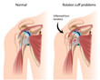Shoulder Impingement , eps8