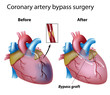 Heart bypass surgery, eps8