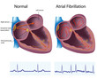 Atrial fibrillation, eps8